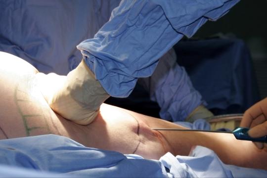 Liposuction plastic surgery procedure