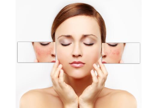 Woman examining skin for broken capillaries